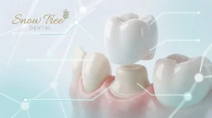 A clinical illustration demonstrating how ceramic dental crowns are placed over a prepared natural tooth to restore its structural integrity.
